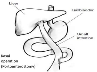 Kasai
operation
(Portoenterostomy)
 