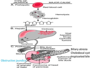 Biliary atresia
Choledocal cyst
Inspisseted bile
Obstructive jaundice
 