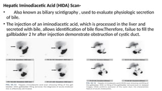 OBSTRUCTIVE JAUNDICE presentation ..pptx