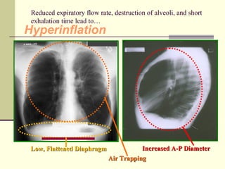 Reduced expiratory flow rate, destruction of alveoli, and short
exhalation time lead to…
Low, Flattened DiaphragmLow, Flattened Diaphragm Increased A-P DiameterIncreased A-P Diameter
Air TrappingAir Trapping
Hyperinflation
 