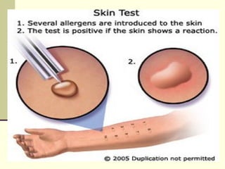Investigations
 Chest X-ray:
Hyper inflated lungs
 Blood tests:
Eosinophils and IgE are usually increased
 Skin prick test:
Should be performed in all cases of asthma to help
identify allergic causes
 
