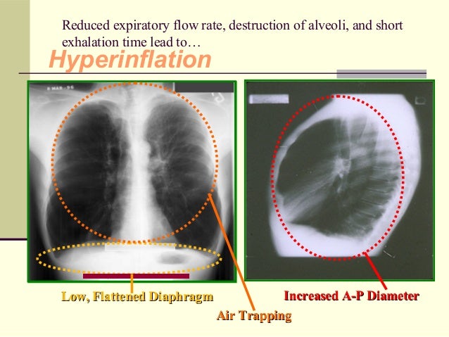 Obstructive lung disease