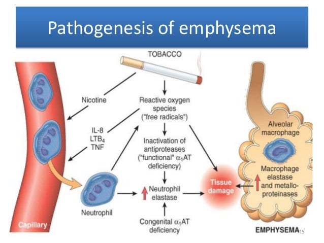Smoking Causes Copd Pathophysiology Red Pastel E