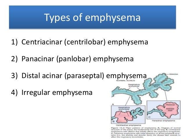 Image result for emphysema types