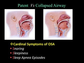 Patent Vs Collapsed Airway
Cardinal Symptoms of OSA
 Snoring
 Sleepiness
 Sleep Apnea Episodes
 