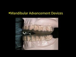 Mandibular Advancement Devices
 