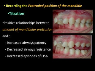 • Recording the Protruded position of the mandible
•Positive relationships between
amount of mandibular protrusion
and :
- Increased airways patency
- Decreased airways resistance
- Decreased episodes of OSA
•Titration
 