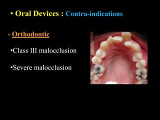 • Oral Devices : Contra-indications
•Class III malocclusion
•Severe malocclusion
- Orthodontic
 