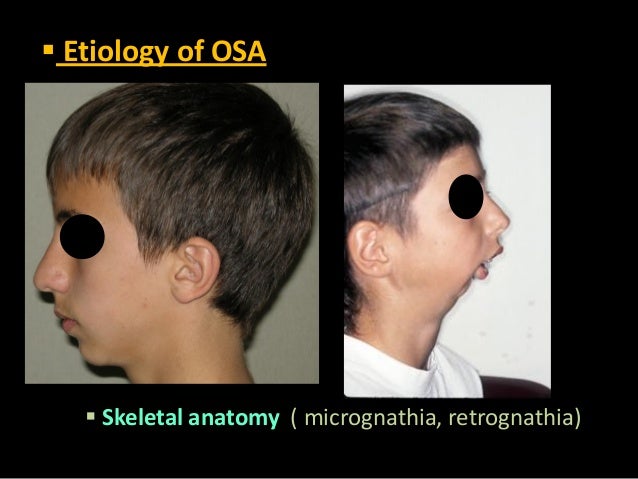 Obstructive sleep apnea