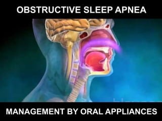 OBSTRUCTIVE SLEEP APNEA
MANAGEMENT BY ORAL APPLIANCES
 