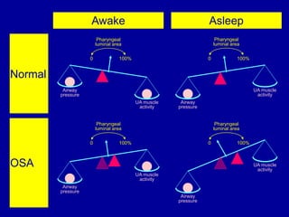 Awake Asleep
Pharyngeal
luminal area
Airway
pressure
UA muscle
activity
Pharyngeal
luminal area
Airway
pressure
UA muscle
activity
0 100%
0 100%
Normal
Pharyngeal
luminal area
Airway
pressure
UA muscle
activity
Pharyngeal
luminal area
Airway
pressure
UA muscle
activity
0 100%
0 100%
OSA
 