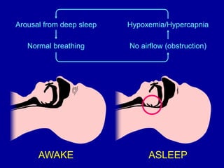 ASLEEP
AWAKE
Normal breathing
Hypoxemia/Hypercapnia
Arousal from deep sleep
No airflow (obstruction)
 