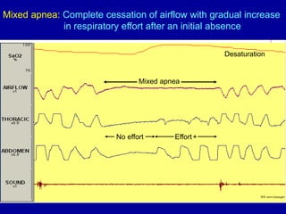 Mixed apnea: Complete cessation of airflow with gradual increase
in respiratory effort after an initial absence
Mixed apnea
No effort Effort+
Desaturation
 