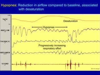 Hypopnea
Desaturation
Progressively increasing
respiratory effort
Hypopnea: Reduction in airflow compared to baseline, associated
with desaturation
 