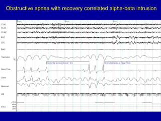 Obstructive apnea with recovery correlated alpha-beta intrusion
 