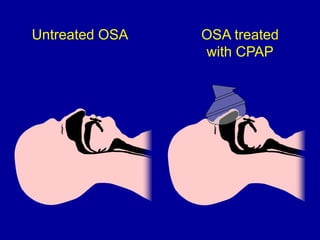 Untreated OSA OSA treated
with CPAP
 
