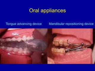 Oral appliances
Mandibular repositioning device
Tongue advancing device
 