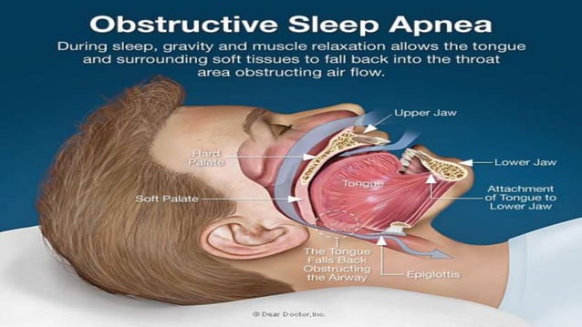 Obstructive Sleep Apnea And Orthognathic Surgery.pptx | Ear, Nose and ...