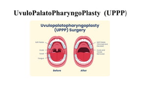 Obstructive Sleep Apnea OSA [Autosaved].pdf