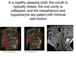 In a healthy sleeping child, the mouth is
typically closed, the oral cavity is
collapsed, and the nasopharynx and
hypopharynx are patent with minimal
wall motion
 