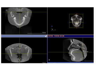 Obstructive sleep apnea (osa)The relationship of airway obstruction and dentofacial structures