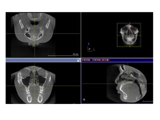 Obstructive sleep apnea (osa)The relationship of airway obstruction and dentofacial structures