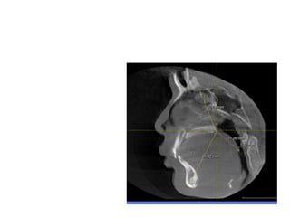 Obstructive sleep apnea (osa)The relationship of airway obstruction and dentofacial structures