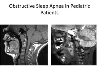 Obstructive Sleep Apnea in Pediatric
Patients
 