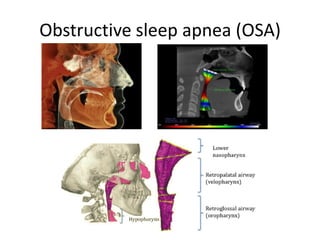 Obstructive sleep apnea (OSA)
 
