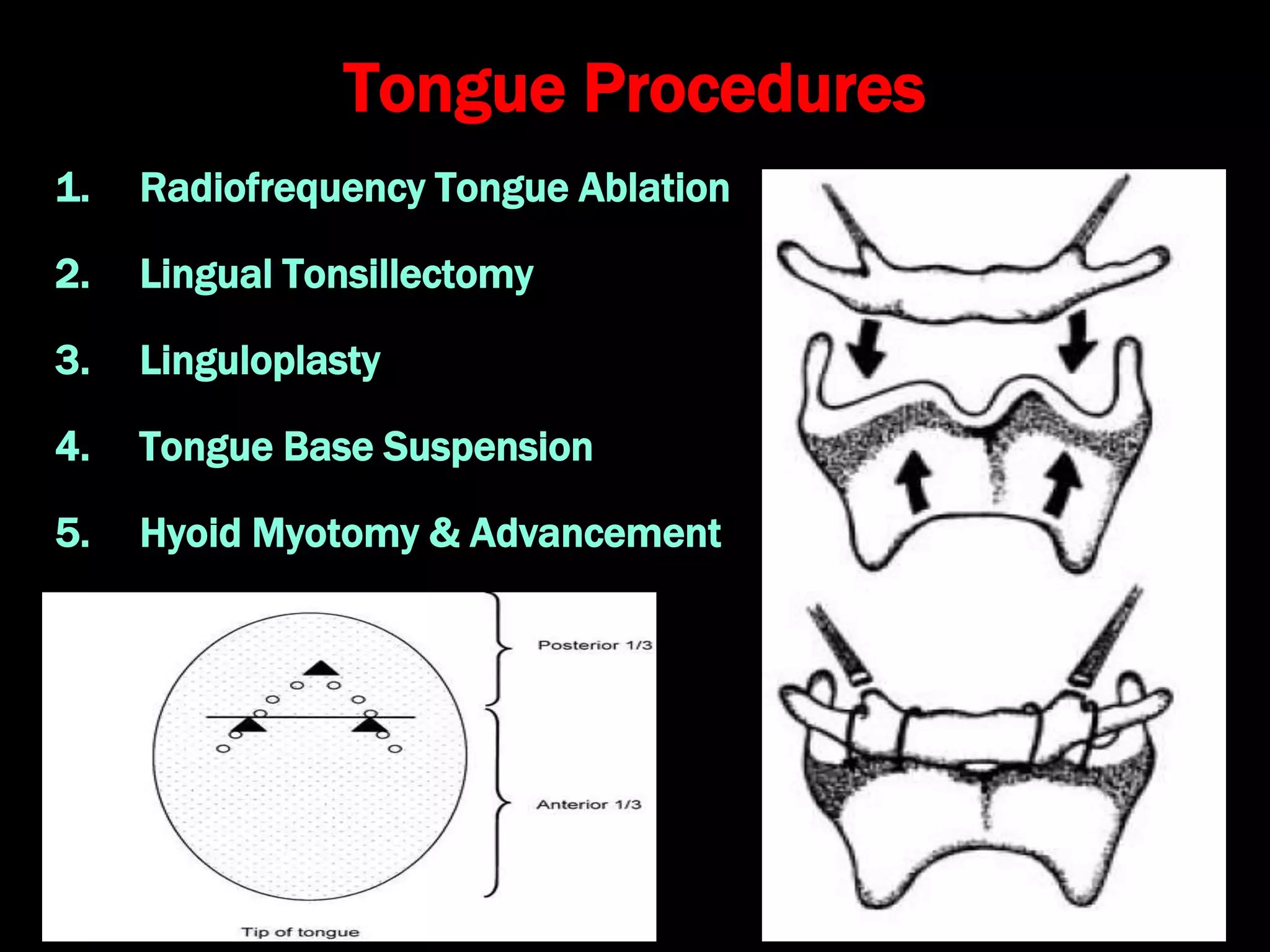 Tongue Procedures
1. Radiofrequency Tongue Ablation
2. Lingual Tonsillectomy
3. Linguloplasty
4. Tongue Base Suspension
5. Hyoid Myotomy & Advancement
 