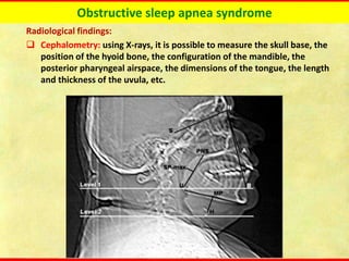 Obstructive sleep apnea syndrome
Radiological findings:
❑ Cephalometry: using X-rays, it is possible to measure the skull base, the
position of the hyoid bone, the configuration of the mandible, the
posterior pharyngeal airspace, the dimensions of the tongue, the length
and thickness of the uvula, etc.
 