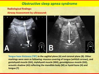 Obstructive sleep apnea syndrome
Radiological findings:
Airway Assessment by ultrasound:
Tongue base thickness (TBT) in the sagittal plane (A) and coronal plane (B). Other
markings were seen as following: mucosa covering of tongue (whitish arrows), and
geniohyoid muscle (GH), mylohyoid muscle (MH), genoidglossus muscle (GG),
acoustic shadow (AS) reflecting the mandible body (M) or hyoid bone (H) and
tongue (T)
 