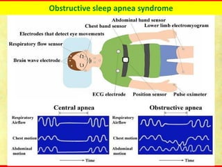 Obstructive sleep apnea syndrome
 