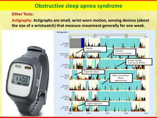 Obstructive sleep apnea syndrome
Other Tests:
Actigraphy: Actigraphs are small, wrist-worn motion, sensing devices (about
the size of a wristwatch) that measure movement generally for one week.
 