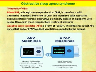 Obstructive sleep apnea syndrome
Treatment of OSA:
Bilevel PAP, although more expensive than CPAP, is therefore a valid
alternative in patients intolerant to CPAP and in patients with associated
hypoventilation or chronic obstructive pulmonary disease or in patients with
severe OSA and in those requiring high treatment pressures
Adaptive servo-ventilatio (ASV) is a form of "BiPAP". The difference is that ASV
varies IPAP and/or EPAP to adjust ventilation as needed by the patient.
 
