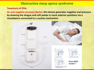 Obstructive sleep apnea syndrome
Treatment of OSA:
An oral negative pressure device: this device generates negative oral pressure
by drawing the tongue and soft palate in more anterior positions via a
mouthpiece connected to a suction mechanism
 