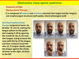 Obstructive sleep apnea syndrome
Treatment of OSA:
Myofunctional Therapy:
It is composed of isotonic and isometric exercises that target oral (lip, tongue)
and oropharyngeal structures (soft palate, lateral pharyngeal wall)
Oro-facial myofunctional
therapy assigned at home: (A,
B) letter ‘O’ and ‘A’, making the
tongue adhere to the palate
and snaping it off by opening
the mouth (A–O); (C, D) nose-
chin tongue, trying to touch the
nose with the tip of the tongue,
and then, trying to touch the
chin; (E, F) tongue-cheeks, push
the tongue against the cheek,
10 times to the right, 10 times
to the left.
 