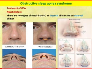 Obstructive sleep apnea syndrome
Treatment of OSA:
Nasal dilators:
There are two types of nasal dilators, an internal dilator and an external
dilator
 