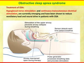Obstructive sleep apnea syndrome
Treatment of OSA:
Hypoglossal nerve stimulation: and continuous transcutaneous electrical
stimulation, are currently emerging and have been shown to reduce
ventilatory load and neural drive in patients with OSA
 