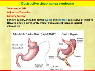 Obstructive sleep apnea syndrome
Treatment of OSA:
Adjunctive Therapies:
Bariatric Surgery:
Bariatric surgery, including gastric bypass and bandage, can resolve or improve
OSA and offers a significantly greater improvement than nonsurgical
alternatives
 
