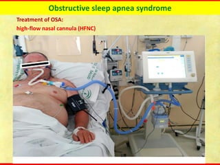 Obstructive sleep apnea syndrome
Treatment of OSA:
high-flow nasal cannula (HFNC)
 