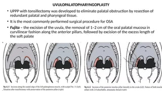 Uvula Incision OBSTRUCTIVE SLEEP APNOEA- features and management | PPTX