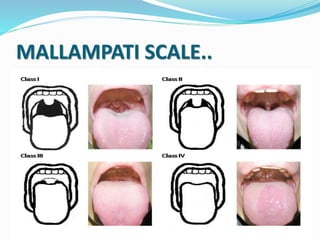 MALLAMPATI SCALE..
 