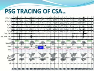 PSG TRACING OF CSA..
 