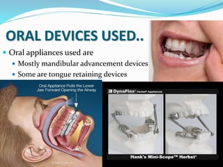 ORAL DEVICES USED..
 Oral appliances used are
 Mostly mandibular advancement devices
 Some are tongue retaining devices
 