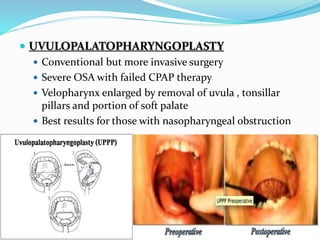  UVULOPALATOPHARYNGOPLASTY
 Conventional but more invasive surgery
 Severe OSA with failed CPAP therapy
 Velopharynx enlarged by removal of uvula , tonsillar
pillars and portion of soft palate
 Best results for those with nasopharyngeal obstruction
 