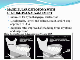  MANDIBULAR OSTEOTOMY WITH
GENIOGLOSSUS ADVANCEMENT
 Indicated for hypopharyngeal obstruction
 Developed by Powell and colleagues as Stanford step
approach to OSA
 Response rates improved after adding hyoid myotomy
and suspension
 