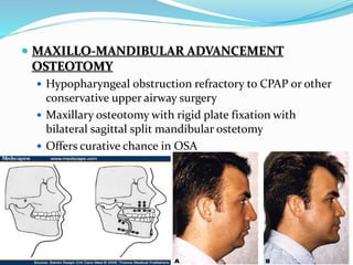  MAXILLO-MANDIBULAR ADVANCEMENT
OSTEOTOMY
 Hypopharyngeal obstruction refractory to CPAP or other
conservative upper airway surgery
 Maxillary osteotomy with rigid plate fixation with
bilateral sagittal split mandibular ostetomy
 Offers curative chance in OSA
 
