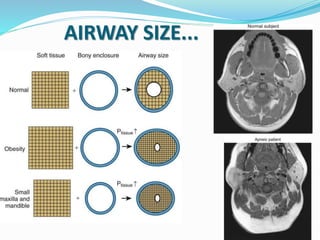 AIRWAY SIZE...
 