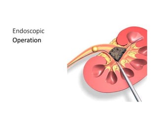 Endoscopic
Operation
